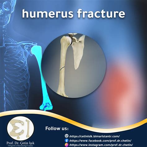 axial compression test humerus fracture|humerus fracture etiology.